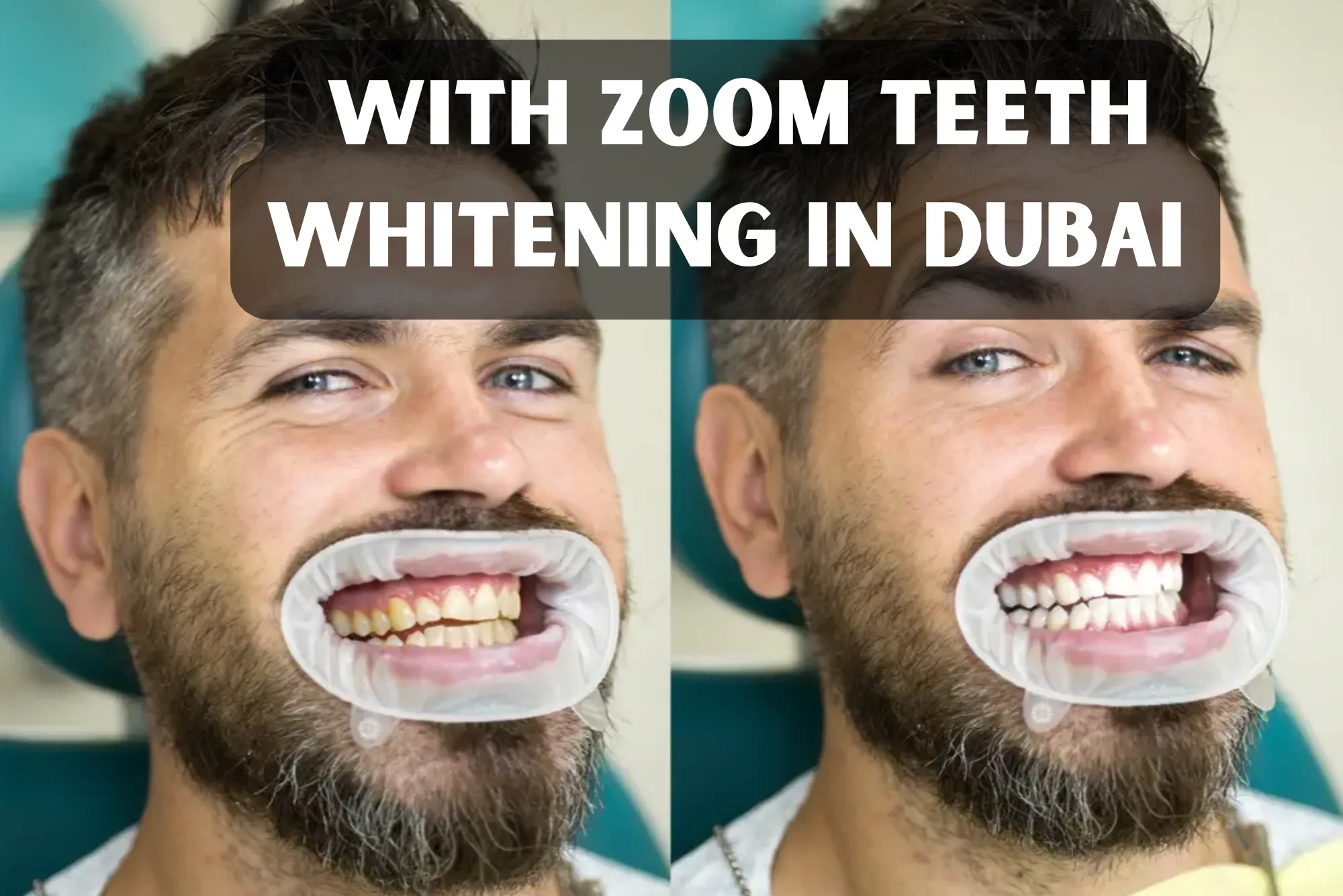 Revitalize Your Smile with Zoom Teeth Whitening in Dubai